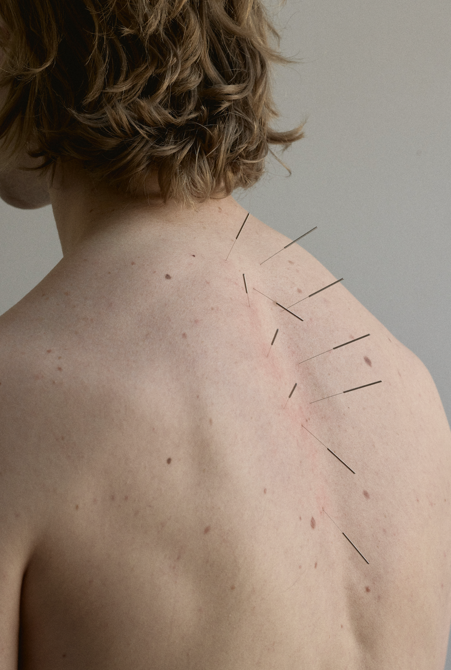 Acupuncture needles placed along a patient’s upper back